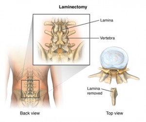 Back view of lumbar vertebra with a portion of bone removed to relieve pressure on the spine.